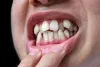 Correct Rotated Teeth: Expert Orthodontic Solutions