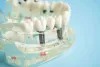 Common Dental Implant Problems And Solutions