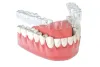 The Connection Between Invisalign and Gum Health