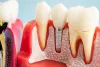 Is Dental Implant Surgery Painful? Here’s What You Need to Know