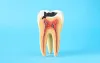 Why Does Tooth Decay Happen?
