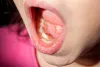 What to Do When Your Child Has Shark Teeth?