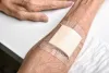 Unveiling the Healing Potential of ActivHeal Aquafiber AG Dressings