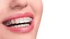 Invisalign Colorado Springs