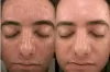 Vampire Facial in Dubai &amp; Abu Dhabi | PRP For Face Cost