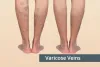 Dr. Abhilash Sandhyala | Best Vascular Specialist In Hyderabad