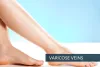 Varicose Veins Surgery Hyderabad - Varicose Veins Laser Treatment Telangana, AP
