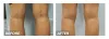 Treatments For varicose vein in Texas