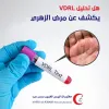 هل تحليل VDRL يكشف عن مرض الزهري؟ | مختبر أنيس الخير للتحاليل الطبية