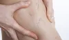 Exercises to Help Relieve Hip Bursitis Pain