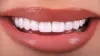 Veneers Magic: Finding the Best Veneer Dentist in Your Locality 