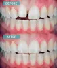 Porcelain Veneers Treatment in Potranco Road San Antonio, TX 78253