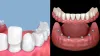 Dental Veneers vs. Dental Implants | PCE