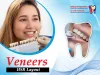 Common Myths About Veneers - Debunked