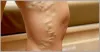 Varicose Vein Treatment In Pune - Spider Vein Treatment Pune