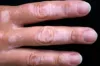Vitiligo Treatment Cost in Delhi