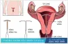 Vừa tháo vòng đã có thai có sao không? Có ảnh hưởng gì không?