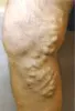 Varicose vein specialist in Pune