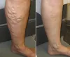 best spider vein doctor