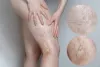 Vein Clinics NJ