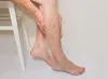 Varicose Veins: Causes, Symptoms, and Treatments