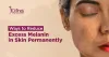 Ways to Reduce Excess Melanin in Skin Permanently - Skin Solutionz
