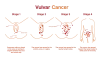 About Vulvar Cancer & Types and stages of vulva cancer 