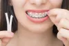 What are Dental Braces, and Why Do We Need Them? - Article Vibe