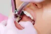 What Happens During an Emergency Dental Extraction? | Katy, TX