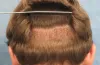 What happens when you get a FUE Hair Transplant? – Health Administrator