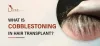 What is Cobblestoning in Hair Transplant ?
