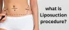 What is liposuction procedure and how does it reduce extra fat?