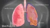 Types of Mesothelioma Cancer