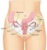 TREATMENT OF UTERINE CANCER