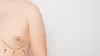 Gynecomastia or Breast Enlargement in Men
