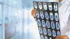 Types of Brain Tumor: Risk Factors, Signs and Symptoms
