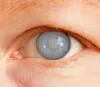 Best glaucoma specialist in mumbai | Glaucoma treatment in mumbai