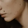 Dermoscopy Mole Evaluation in Dubai &amp; Abu Dhabi | Mole Mapping Cost