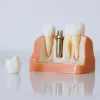 Why I Need Temporary Dental Crown After Implants | El Paso