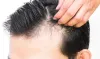 Why should one go for a Hair Transplant? – Health Clan