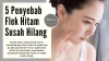 5 Penyebab Kenapa Flek Hitam Di Wajah Susah Hilang - Natureve Store