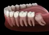 How to Prepare for Wisdom Teeth Removal? - Tooth
