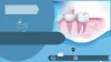 Wisdom Tooth Extraction - Gifyu