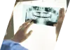 Wisdom Teeth Extraction In Houston TX | Wisdom Teeth Removal Surgery Near me | Oral Surgery