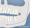 Impacted Wisdom Teeth - Impacted Teeth Removal Treatment Seattle | PSOMS