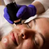 Ultrasound Skin Treatment in Surrey