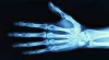 What are the Causes and Treatment of Wrist Fractures?