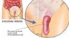 Minimally Access Approach: Laparoscopic Ovarian Cystectomy Explained by Dr. R.K. Mishra -  Free Laparoscopic Videos 