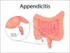 appendix-removal-surgery-in-nerul-navi-mumbai.webp
