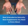 beat20scleroderma20naturally.jpg